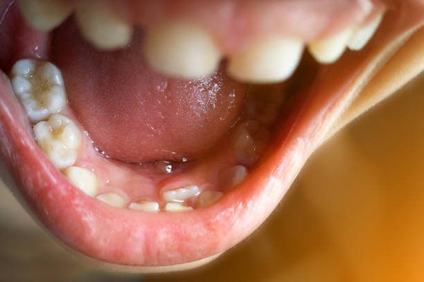 Shark Teeth in Children